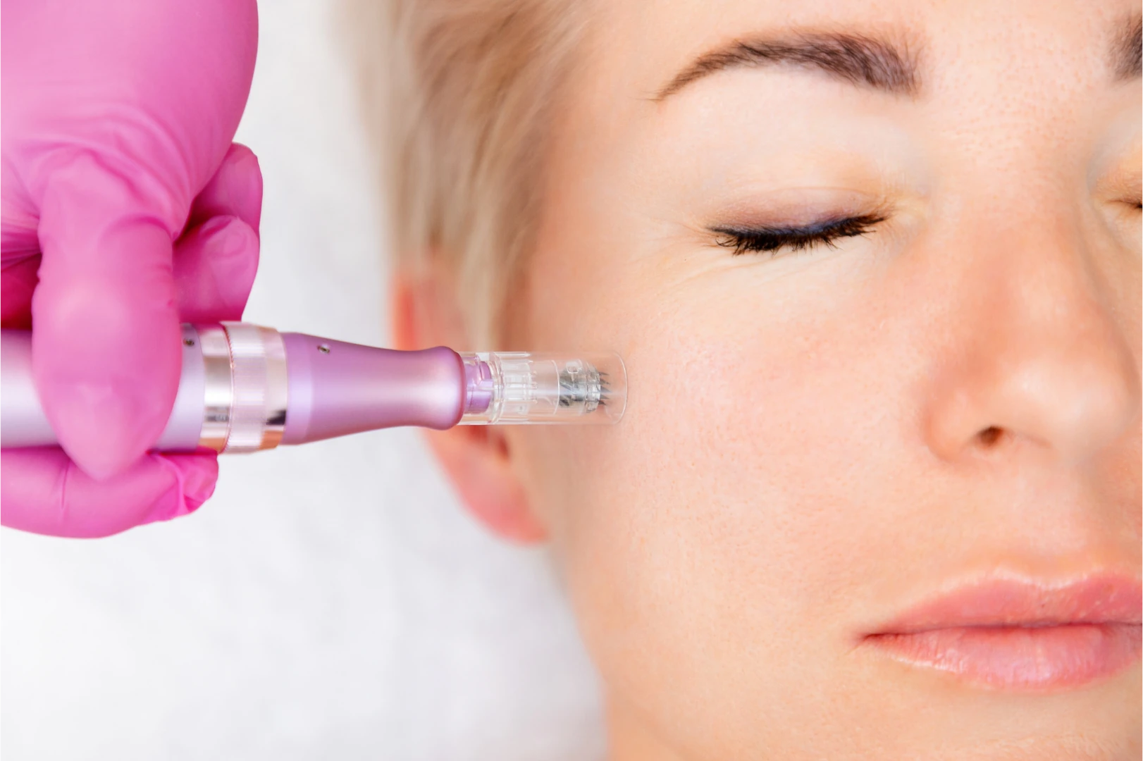 Plasma con Microneedling